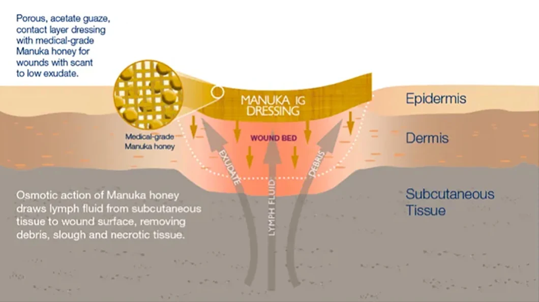 Medical Functional Honey Gauze Dressing for Wound Care